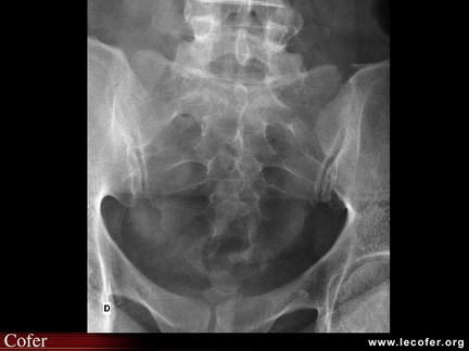 Radiographie du sacrum