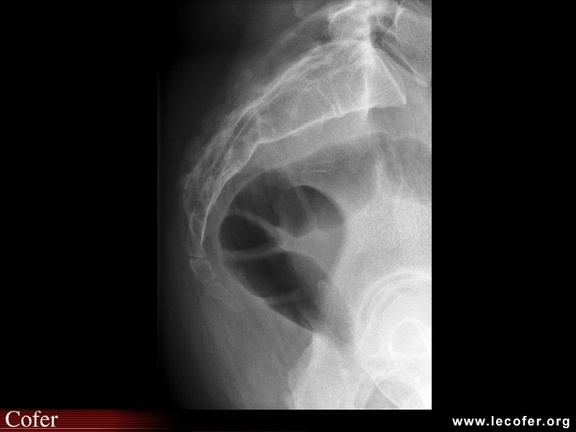 Radiographie du coccyx