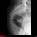 Radiographie du coccyx