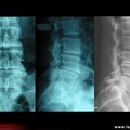 Radiographie du rachis : discopathie arthrosique : face / profil / avec vide discal