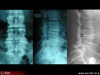 Radiographie du rachis : discopathie arthrosique : face / profil / avec vide discal