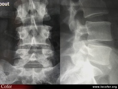 Radiographie du rachis : discopathie destructrice rapide : face / profil