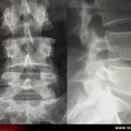 Radiographie du rachis : discopathie destructrice rapide : face / profil