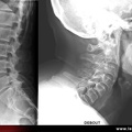 Radiographie du rachis : arthrose lombaire inter-apophysaire postérieure lombaire / cervicale