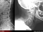 Radiographie du rachis : arthrose lombaire inter-apophysaire postérieure lombaire / cervicale