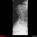 Radiographie : spondylolisthésis par lyse dégénérative