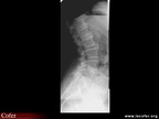 Radiographie : spondylolisthésis par lyse dégénérative