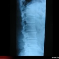 Radiographie : maladie de Scheuermann (profil)