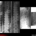 Radiographie : maladie de Forestier (face, profil)