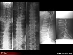Radiographie : maladie de Forestier (face, profil)