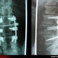 Radiographie : arthrodèse lombaire (face / profil)