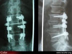 Radiographie : arthrodèse lombaire (face / profil)