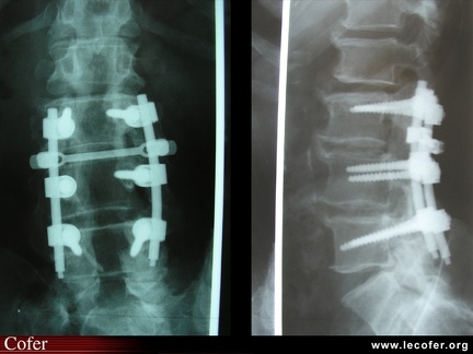 Radiographie : arthrodèse lombaire (face / profil)