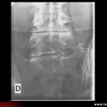 Radiographie : néo-articulation transverso-sacrée de face