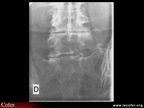 Radiographie : néo-articulation transverso-sacrée de face