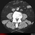 Lipomatose épidurale : scanner