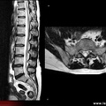 IRM lombaire : sujet normal sagittal / axial