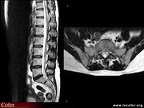 IRM lombaire : sujet normal sagittal / axial