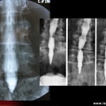 Saccoradiculographie : face sujet normal / canal lombaire rétréci