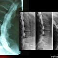 Saccoradiculographie : Profil sujet normal / canal lombaire rétréci