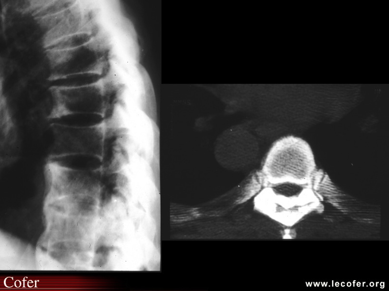 Des lésions osseuses à type d'hyperostose se voient sur le rachis, l'ossification du ligament jaune peut conduire à un rétrécissement du canal médullaire. 090400031.jpg