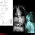 Pathologie du rachis : scoliose et mesure de l’angle de Cobb