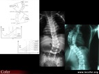 Pathologie du rachis : scoliose et mesure de l’angle de Cobb