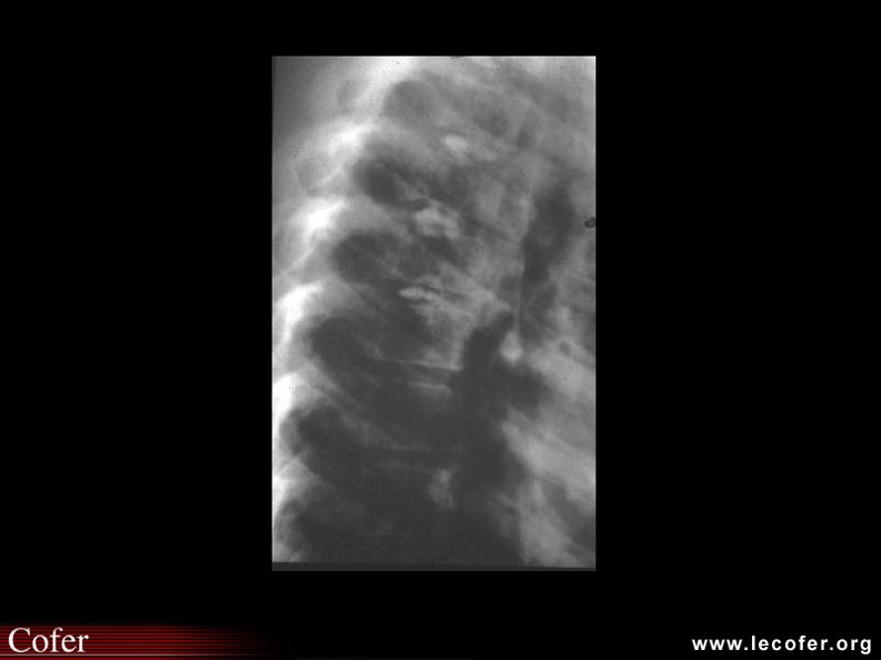 La présence de calcification du nucléus est à l'origine de tableaux aigus de douleur dorsale. Elle peut également survenir au niveau cervical ou lombaire. 100002030.jpg