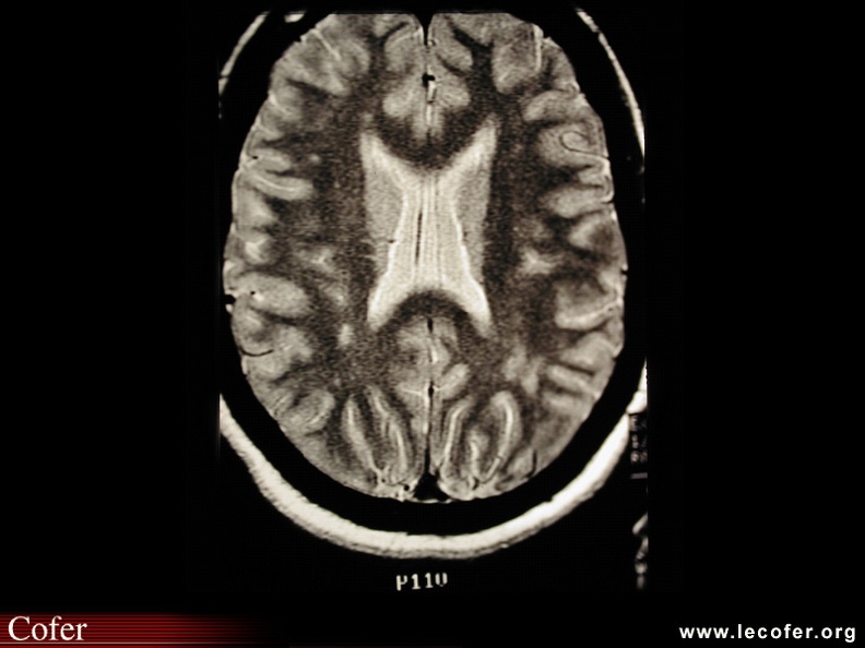 Sarcoïdose : Lésions nodulaires multiples de la substance blanche, dans le cadre d'une neurosarcoïdose. BB020.jpg