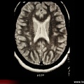 Sarcoïdose neurologique