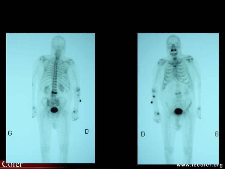 Fracture vertébrale : hyperfixation d'une vertèbre lombaire. 000000000144s.jpg