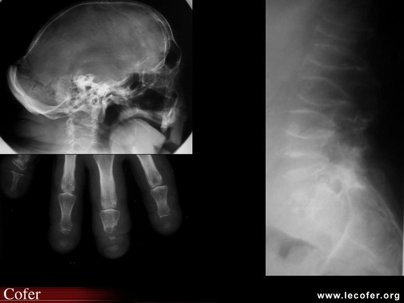 Dysplasie osseuse caractérisée par une acro-ostéolyse progressive, une ostéoporose précoce et une dysplasie faciale (scaphocéphalie). 000000000228.jpg