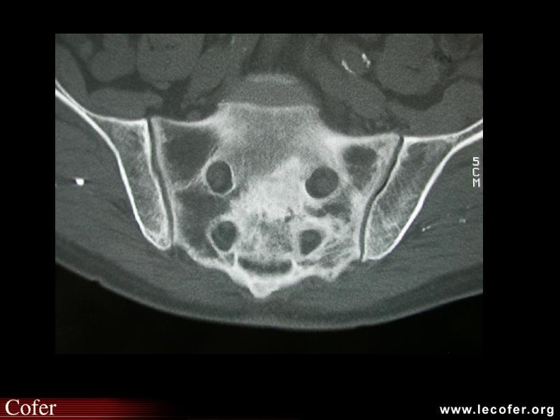 Maladie de Paget (atteinte du sacrum). 000000000274.jpg