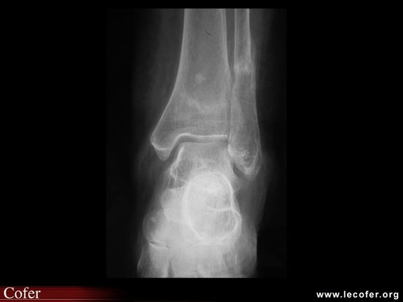 Fracture par insuffisance osseuse du tibia et du péroné, fracture de fatigue