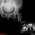 Arthrite tuberculeuse de la symphyse pubienne