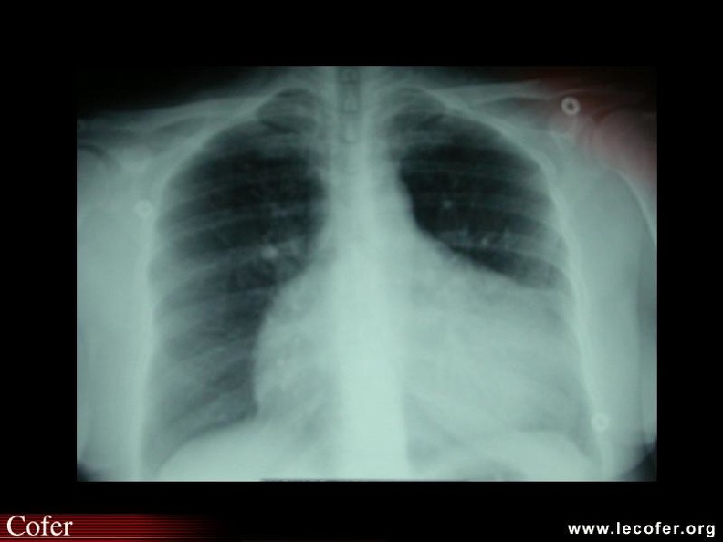 Lupus systémique, lupus érythémateux disséminé, péricardite lupique. 000000000306.jpg