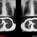 Spondylarthrite ankylosante, spondylarthropathie, SpA : atteinte pulmonaire