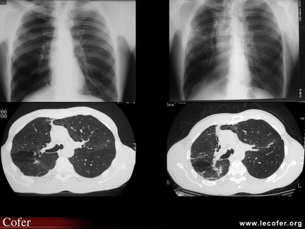 Spondylarthrite ankylosante, spondylarthropathie, SpA : atteinte pulmonaire