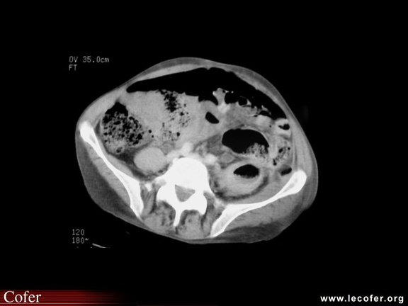 Abcès du psoas gauche compliquant une maladie de Crohn