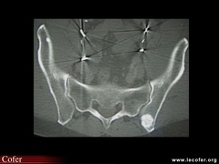 Métastase ostéocondensante du sacrum (cancer de prostate)