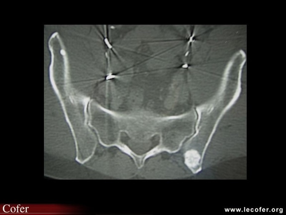 Métastase ostéocondensante du sacrum (cancer de prostate)