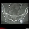 Métastase ostéocondensante du sacrum (cancer de prostate)