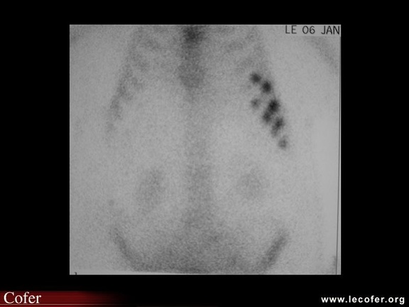 Fracture de fatigue des côtes (scintigraphie osseuse)