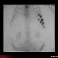 Fracture de fatigue des côtes (scintigraphie osseuse)