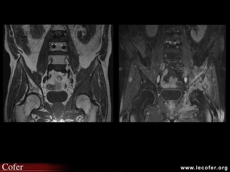 Hyposignal diffus de l'hémi-bassin gauche en pondération T1 avec prise de contraste après injection de gadolinium. 000000000411s.jpg