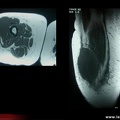 Anomalies musculaires liées à un lymphome (IRM)