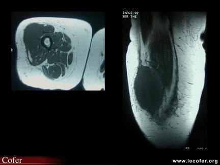 Anomalies musculaires liées à un lymphome (IRM)