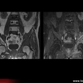 Lymphome du bassin (T1 et T1 FAT SAT gadolimium)