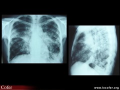 Métastases pulmonaires, localisations pulmonaires diffuses