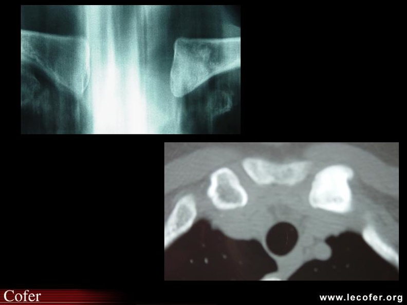 Ostéose condensante de la clavicule : maladie de Brower. 000000000547s.jpg